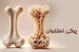 آخرین مقالات خانه زانو - پوکی استخوان دکتر توابی تأثیر تغذیه در پیشگیری و کنترل آرتروز زانو و پوکی استخوان