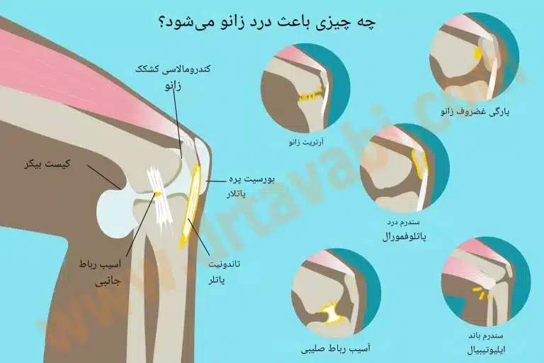 حقایق جالب در مورد غضروف مفصل زانو