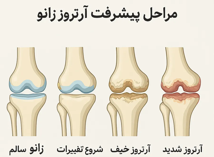 مراحل پیشرفت آرتروز زانو