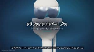 نمای شماتیک پروتز زانو و استخوان نگهدارنده در انیمیشن سلامت استخوان خانه زانو