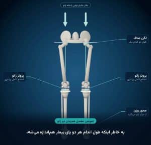 تعویض همزمان دو زانو در زانوی پرانتزی؛ هر دو زانو صاف و طول دو اندام برابر می‌شود