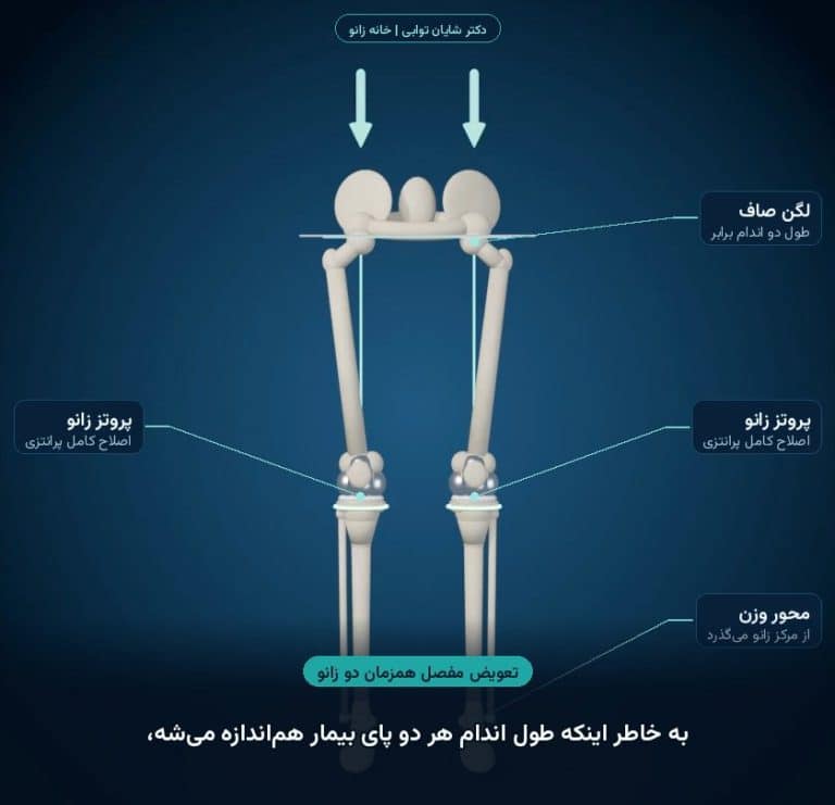 تعویض همزمان دو زانو در زانوی پرانتزی؛ هر دو زانو صاف و طول دو اندام برابر می‌شود