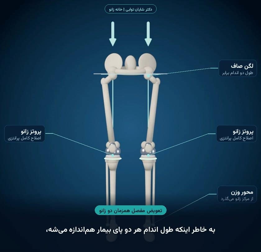 تعویض همزمان دو زانو در زانوی پرانتزی؛ هر دو زانو صاف و طول دو اندام برابر می‌شود