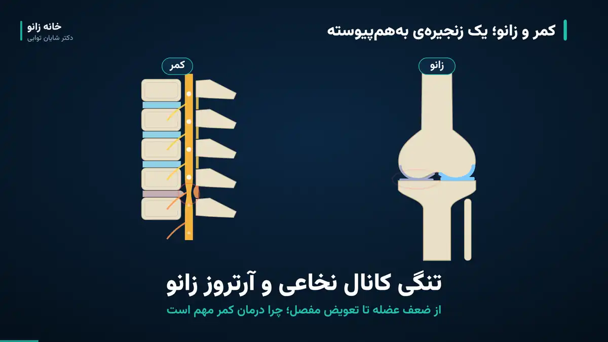 تنگی کانال نخاعی و آرتروز زانو؛ ارتباط و پیشگیری - spinal stenosis knee arthritis تنگی کانال نخاعی و آرتروز زانو؛ تصویر شماتیک مهرههای کمر با محل تنگی کانال و مفصل زانو با سایش غضروف