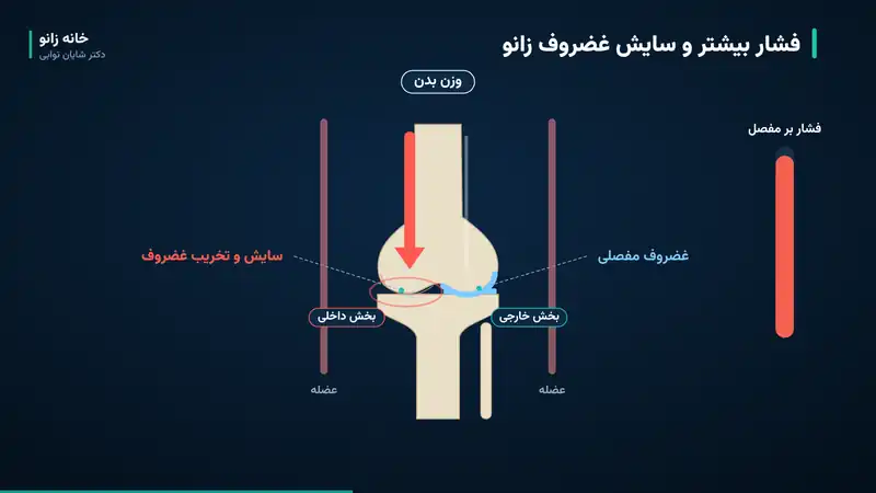 تنگی کانال نخاعی و آرتروز زانو؛ ارتباط و پیشگیری - spinal stenosis knee load cartilage تنگی کانال نخاعی و آرتروز زانو؛ انتقال وزن بدن به بخش داخلی زانو و سایش غضروف پس از ضعف عضلات