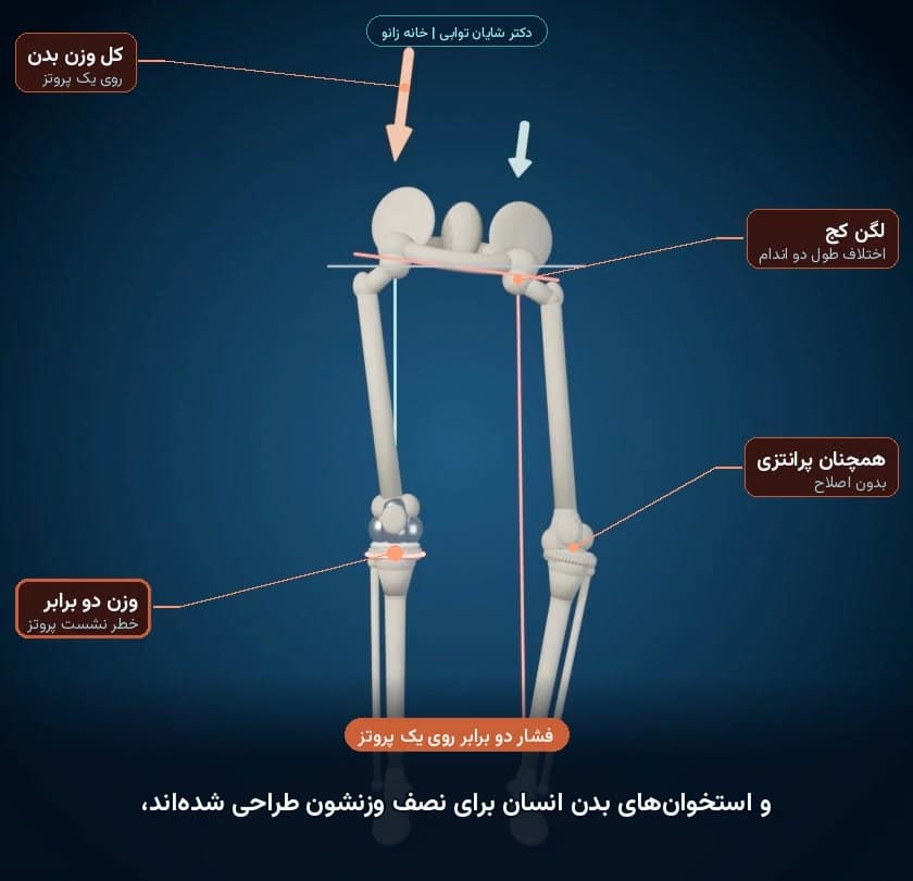 تعویض یک‌طرفه در زانوی پرانتزی دوطرفه: وزن دو برابر روی یک پروتز و خطر نشست پروتز